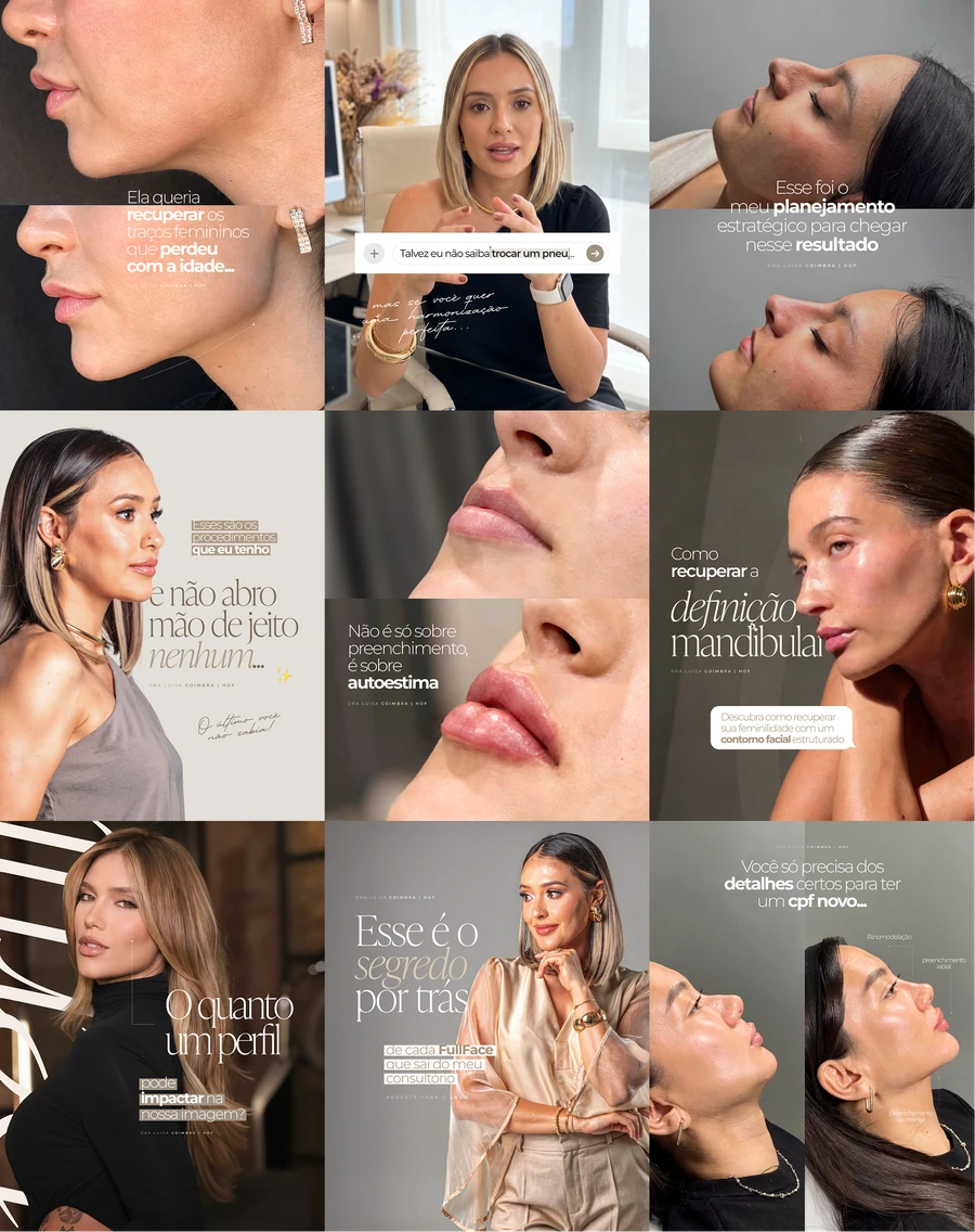 Trabalho da Milano para perfil de harmonização facial